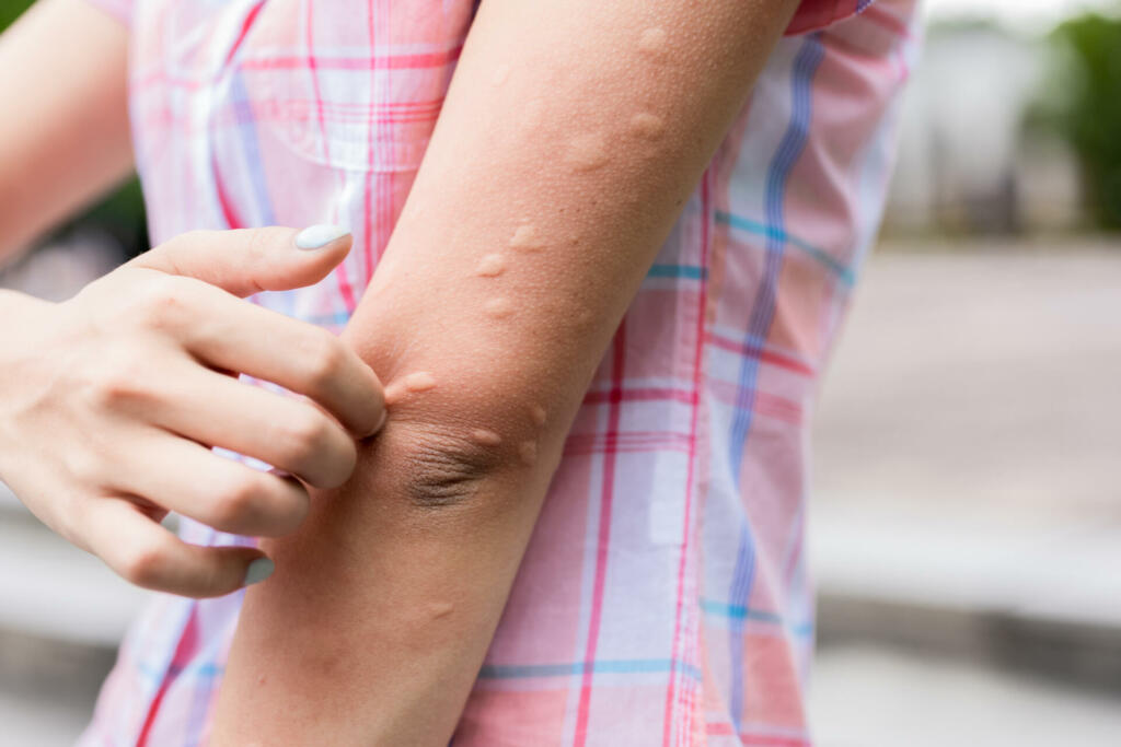 Arm of gilr is bitten by the mosquito and get bumps on her skin in the summer