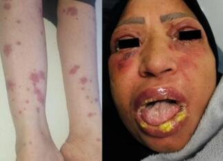 Vzela zdravilo, ki ga uporabljajo tudi Slovenci, potem se je začel pekel! Zdravniki: To je zelo redko … FOTO: Clinical Case Reports