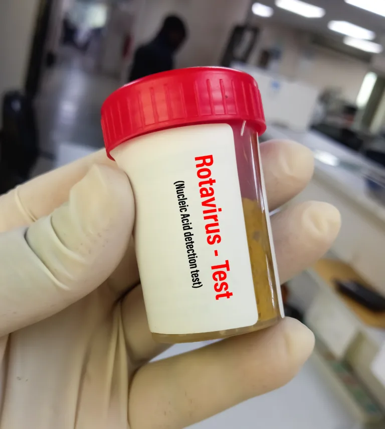 Biochemist hold feces sample for Rotavirus test to diagnose a rotavirus infection. Rotavirus antigen test. viral gastroenteritis.