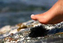 Ste stopili na morskega ježka? Brez panike. Največ ljudi naredi isto napako … walk on a sea urchin at the beach