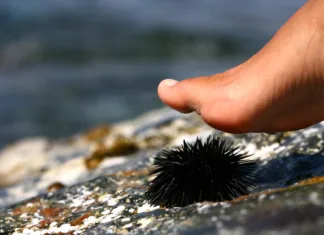 Ste stopili na morskega ježka? Brez panike. Največ ljudi naredi isto napako … walk on a sea urchin at the beach