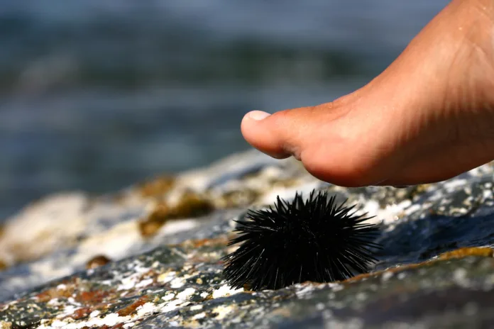 walk-on-a-sea-urchin-at-the-beach-stockpack-istock walk on a sea urchin at the beach